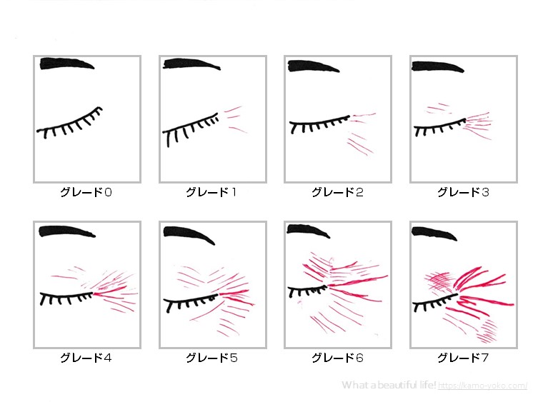 シワグレード１～４までのシワは改善する