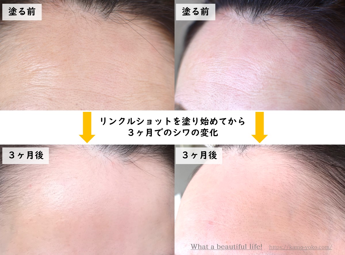 リンクルショットの効果シワ３ヶ月間の変化